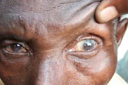 Mass drug treatment for trachoma and scabies
