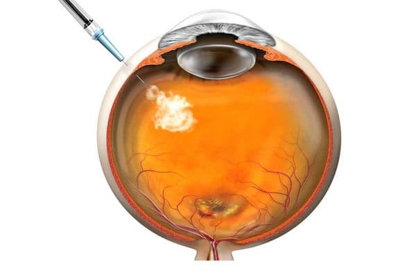 Pandemic’s impact on AMD – increased visual loss
