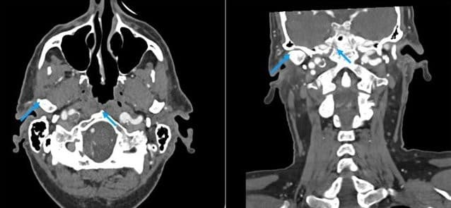 Carotid Dissection
