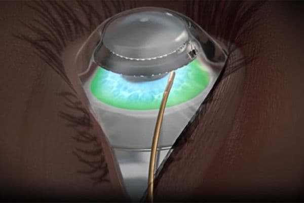 J&J boosts non-invasive refractive tech
