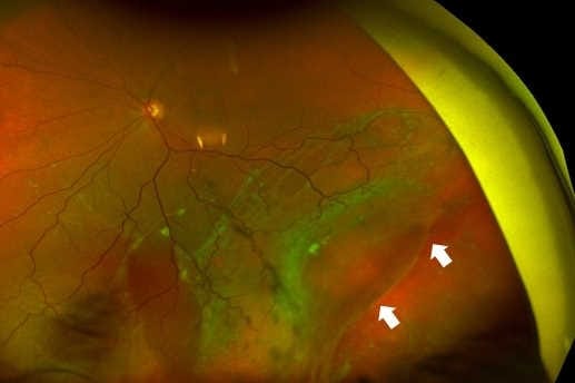 Atopic dermatitis and retinal detachment (1)