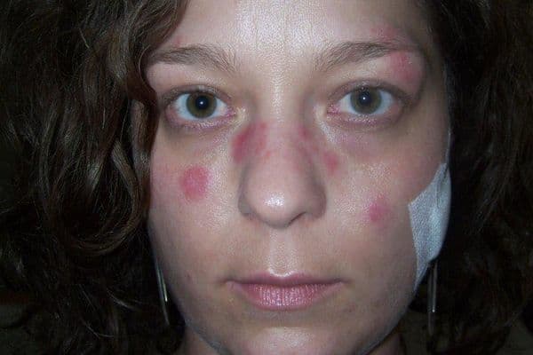 Lupus link with AMD found (1)