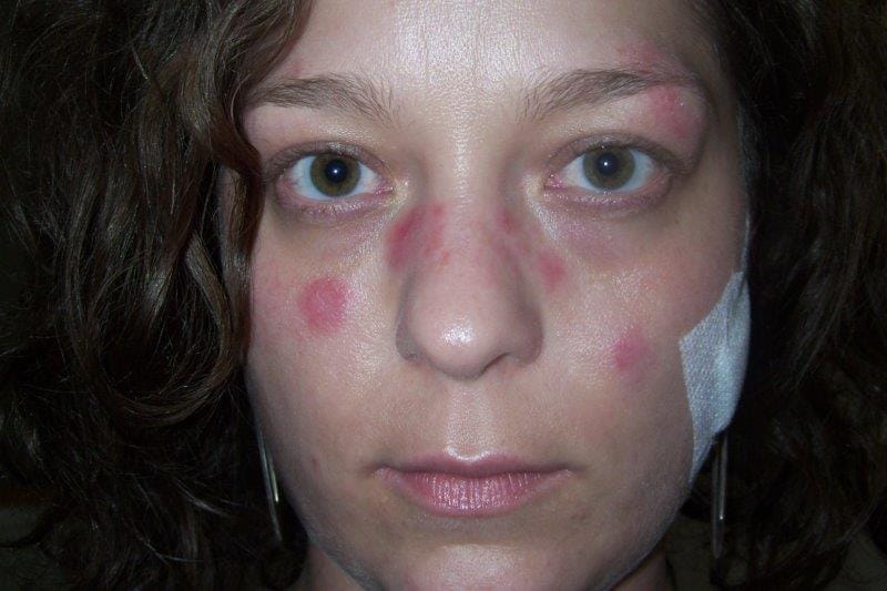 Lupus link with AMD found (1)