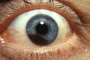 ‘Eye-saving’ oral UM treatment