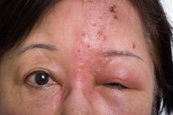 Shingles: a crucial conversation for the over-50s