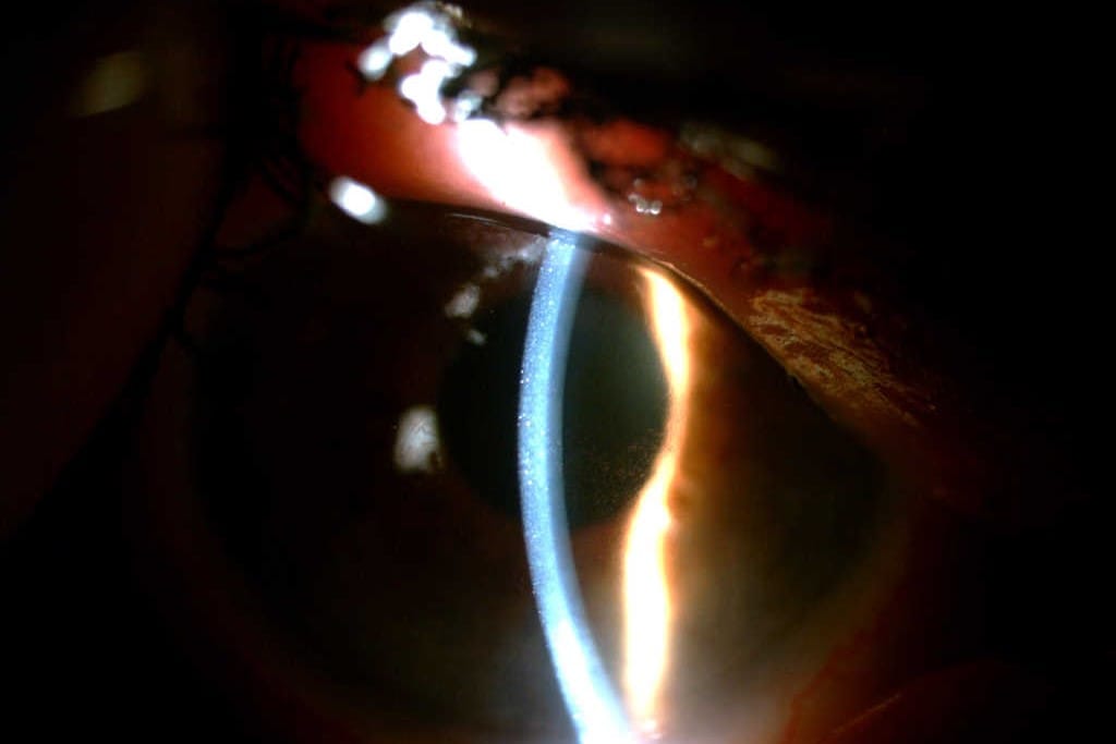 Case study: There was an old lady who fly sprayed her eye…