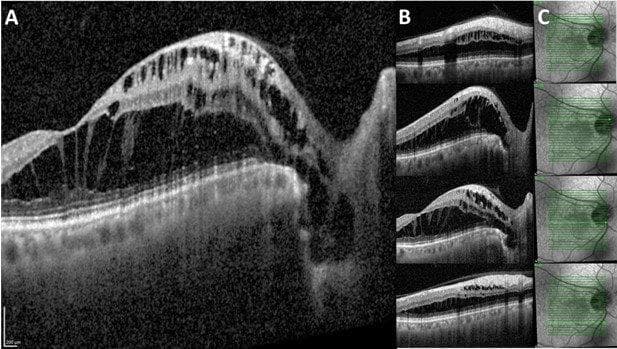 Optic disc pit with maculopathy-fig-3.jpg