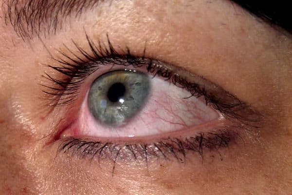 New anti-allergy CLs