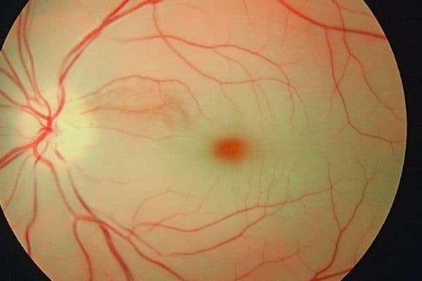 jpgpgwyg central retinal artery occlusion crao online