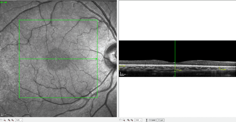 Fig 10 Case Three Pretreatment Choroidal Thickness