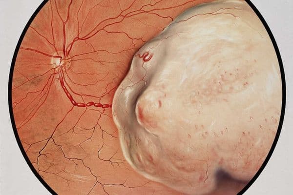 Choroidal melanoma treatment advances