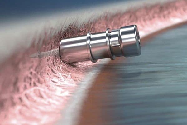 Glaukos makes MIGS and CXL inroads