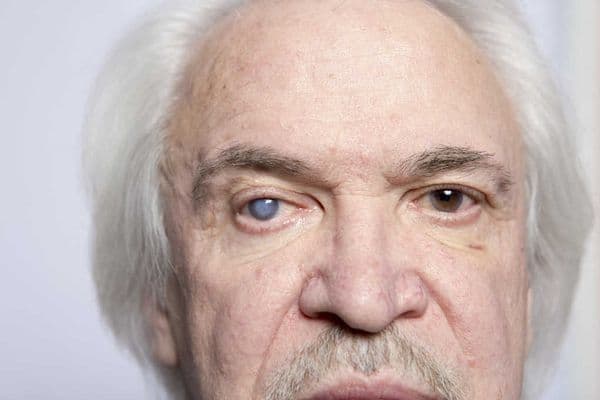 Anti-cataract implant study underway
