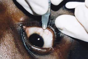 IVT injections unnecessary in a third of nAMD patients (1)