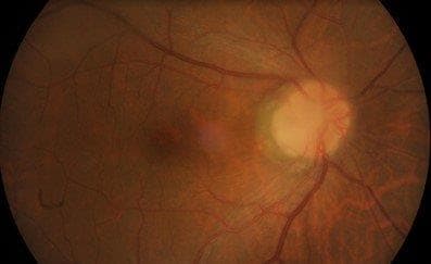 Optic disc pit with maculopathy-fig-2.jpg