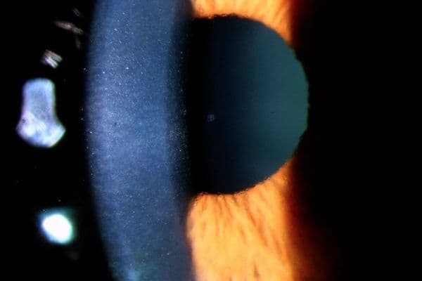 lgwlkwtv auckland eye article image corneal research review