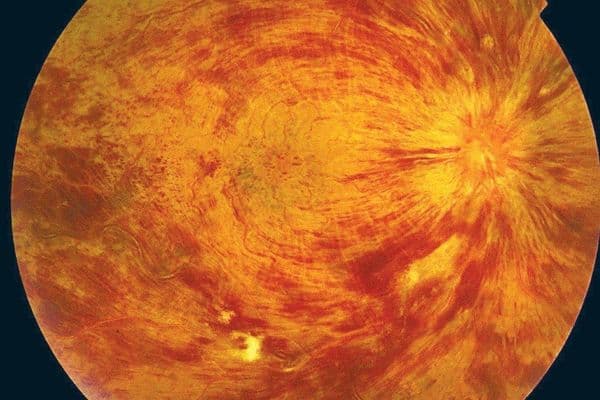 CRVO: 3-year anti-VEGF outcomes