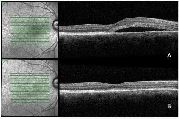 Central serous chorioretinopathy cases