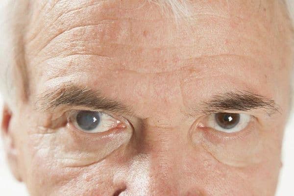 Cataract surgery lowers IOP