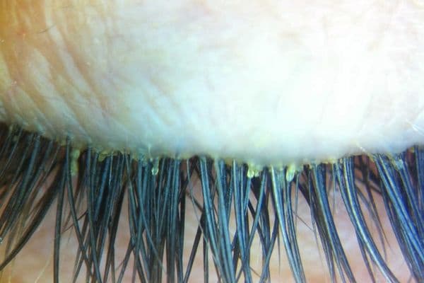 OSL: Demodex research update