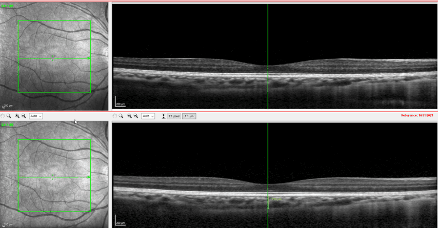 Fig 7 Case Two Choroidal Thickness At Two Month Follow Up Exam