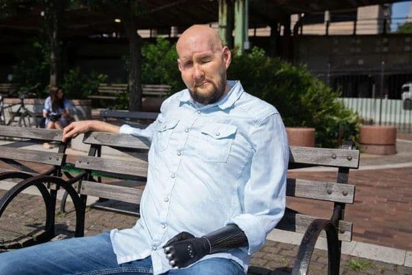 ngskkigj aaron james eye partial face transplant recipient one year later