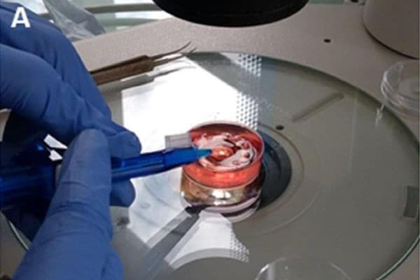 3D printing to revolutionise cataracts treatment?