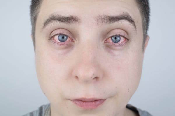 Drops suppress allergic eye disease (1)