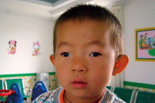 LD atropine safe in myopes with exotropia