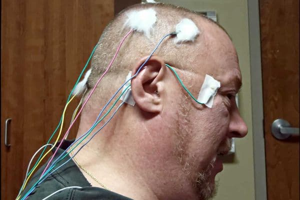 Electrical stimulation reduces CBS hallucinations