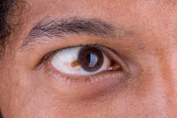 Metastatic risk in conjunctival melanoma