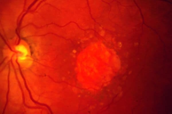 ogyliune geographic atrophy ga