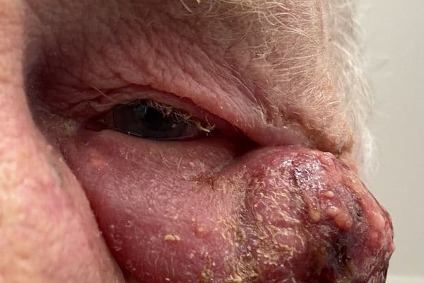 Rare report of orbital pyoderma gangrenosum