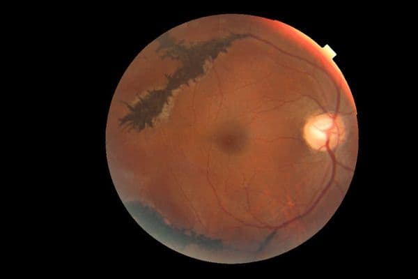 Early red flags for adult pathologic myopia