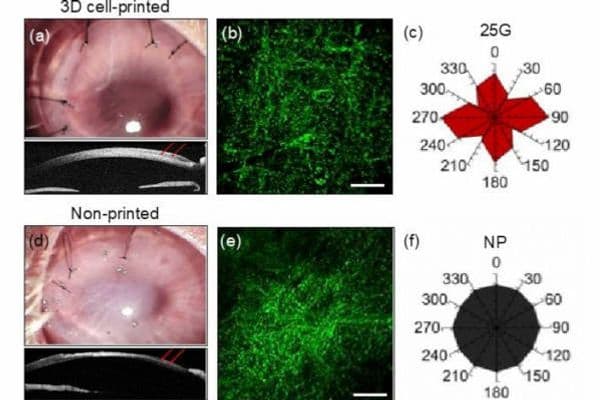 3D-printed cornea breakthrough