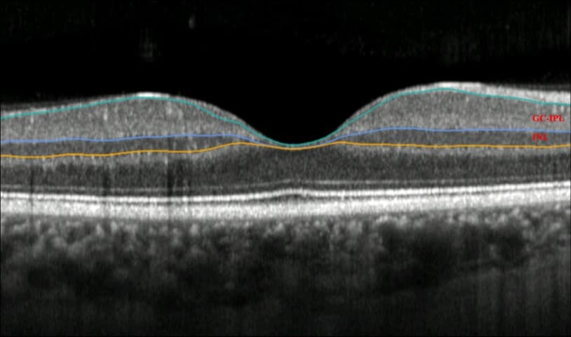 OCT and AI flag Parkinson’s risk-an-oct-scan-of-a-retina-with-the-highlighted-individual-layers.jpg