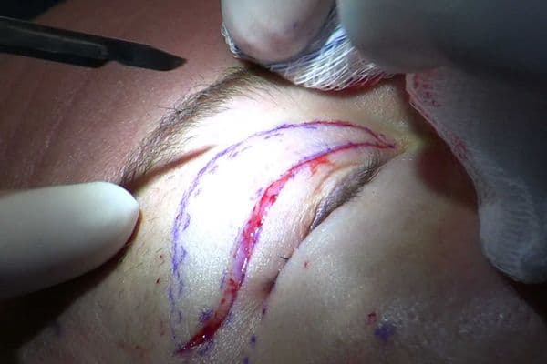 Australia tightens cosmetic surgery rules