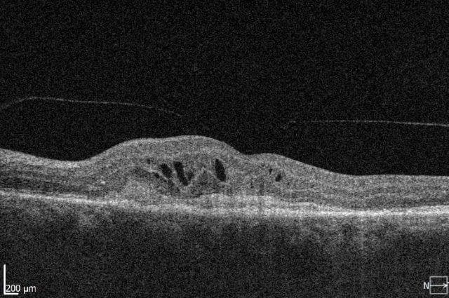 Established and emerging trends in AMD management-figure-1-fibrosis-left-macular.jpg