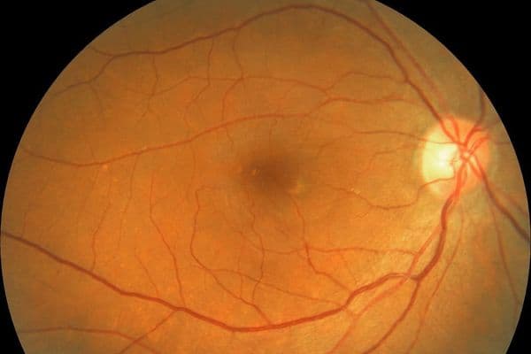 macular telangiectasia mactel type 2 online