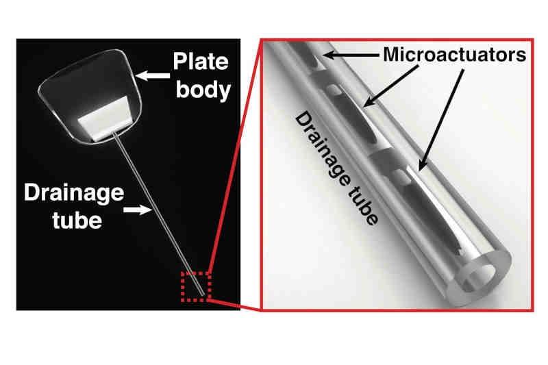 Self-cleaning, customised-flow glaucoma device