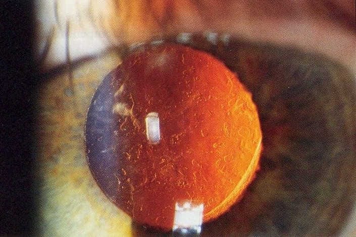 Comment: YAG laser optometry scope change