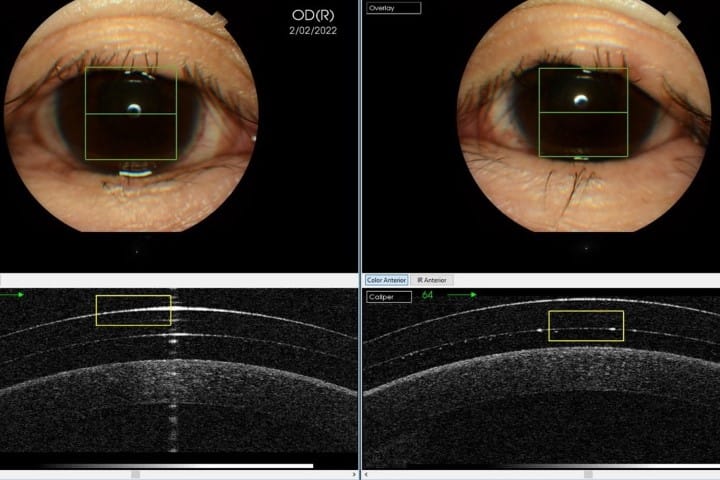 Scleral lenses and ocular surface disease