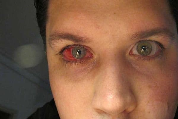 Keratoplasty rejection after Covid vaccination (1)