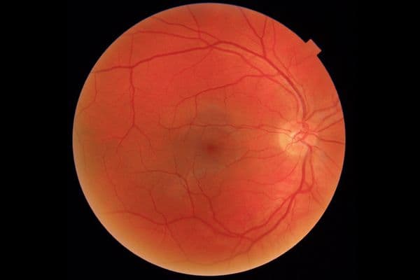rpmhwekm moorfields fundus online