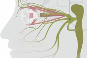 Specs for headaches?