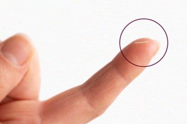 Trabeculectomy superior to Xen45 stent