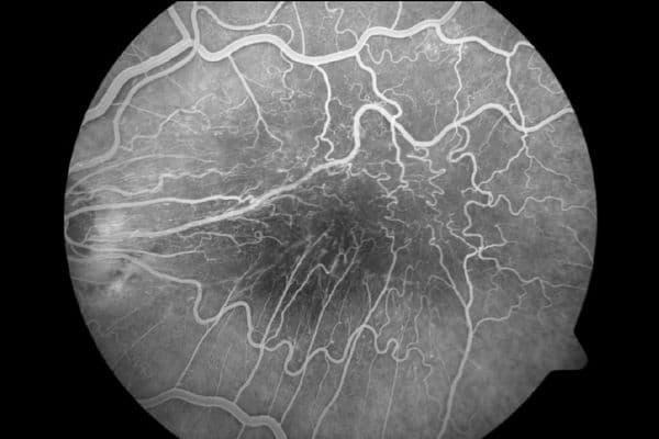 tmupckzf epiretinal membrane online
