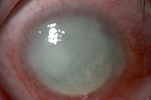 Acanthamoeba meets its match