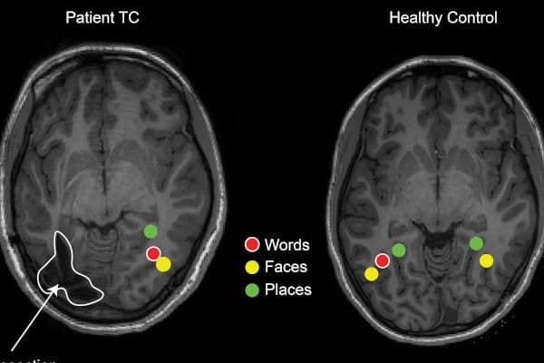 Epileptic kids compensate for lost brain tissue