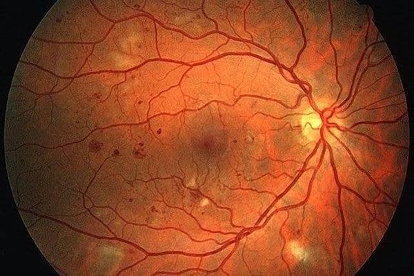 Retinal cells’ glucose defence